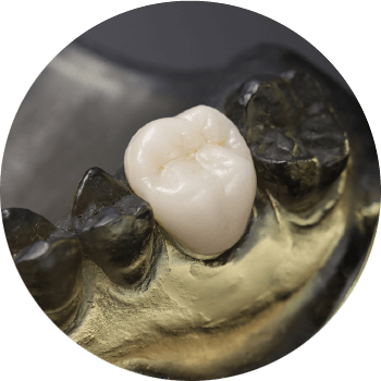 オールセラミックス(e-MAX)